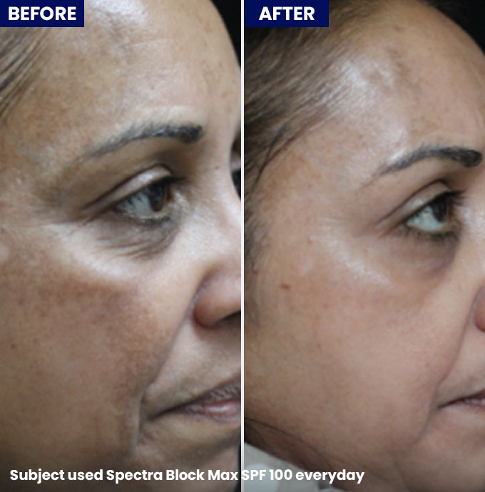 Jenpharm-Spectrablock Max SPF 100 Tinted Sunscreem